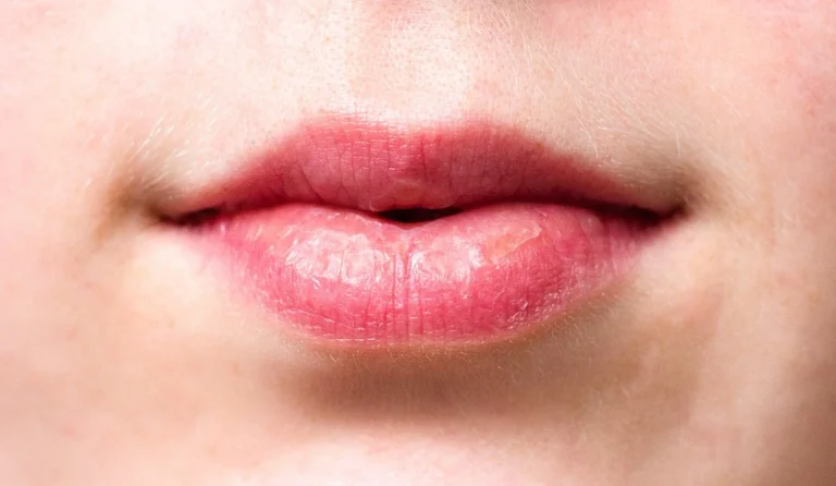 Cara Mengatasi Bibir Kering Saat Puasa dengan Mudah